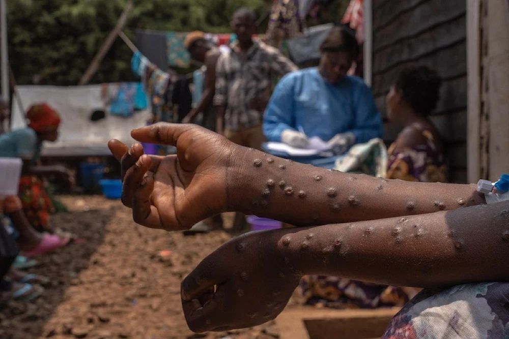 La epidemia de mpox en África "no está bajo control"