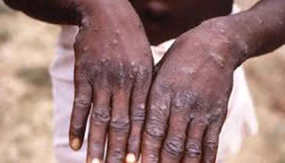 RDC: conflicto aumenta riesgo de propagación de cólera y Mpox