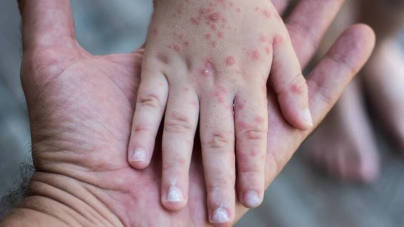 Brote de sarampión en Texas suma 683 casos por rechazo a vacunas
